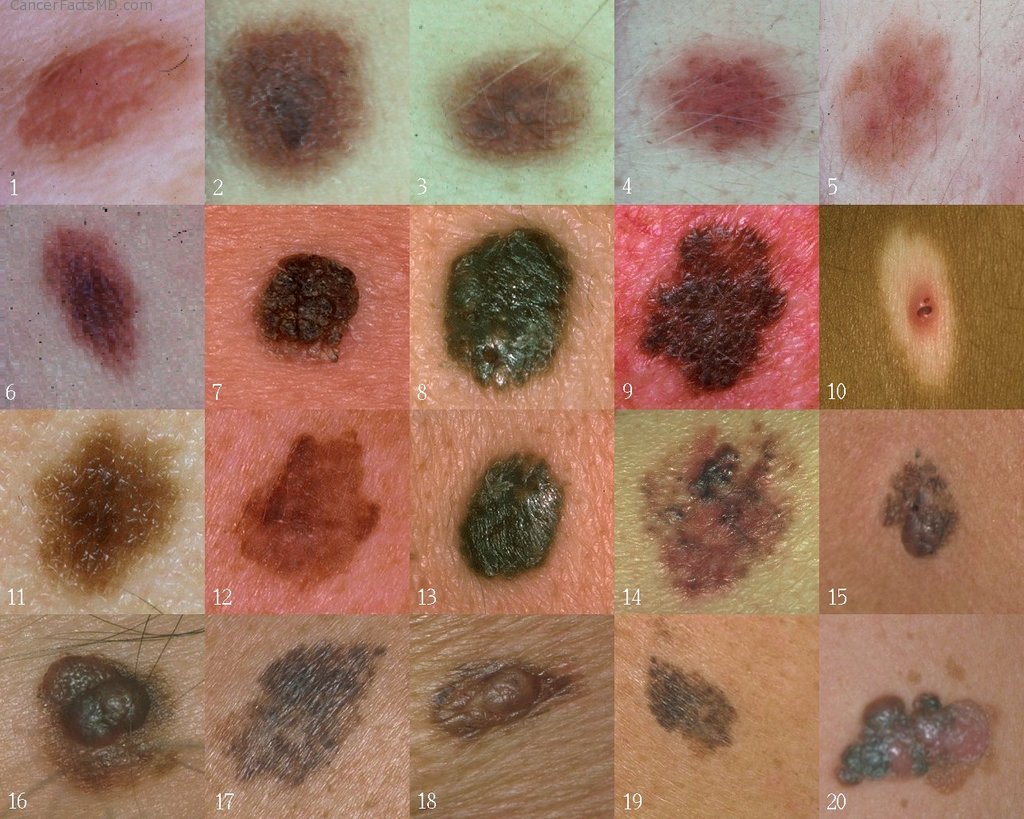 Examples of skin cancer. Melanoma is the most common form of skin cancer.