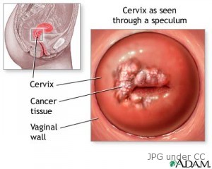 cervical cancer