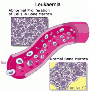 leukemia