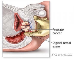 prostate cancer