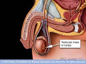 testicular-cancer-lumps