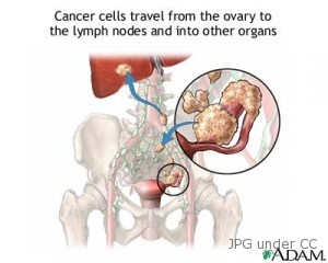 ovarian cancer